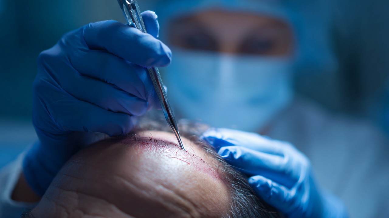 Close-up of a medical professional performing a follicular unit extraction (FUE) hair transplant in a modern clinic, focusing on precise follicle removal.