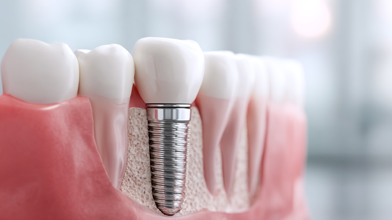 Imagem de um implante dentário de titânio sendo colocado cirurgicamente na mandíbula por um dentista em clínica moderna, com gengiva saudável ao redor.