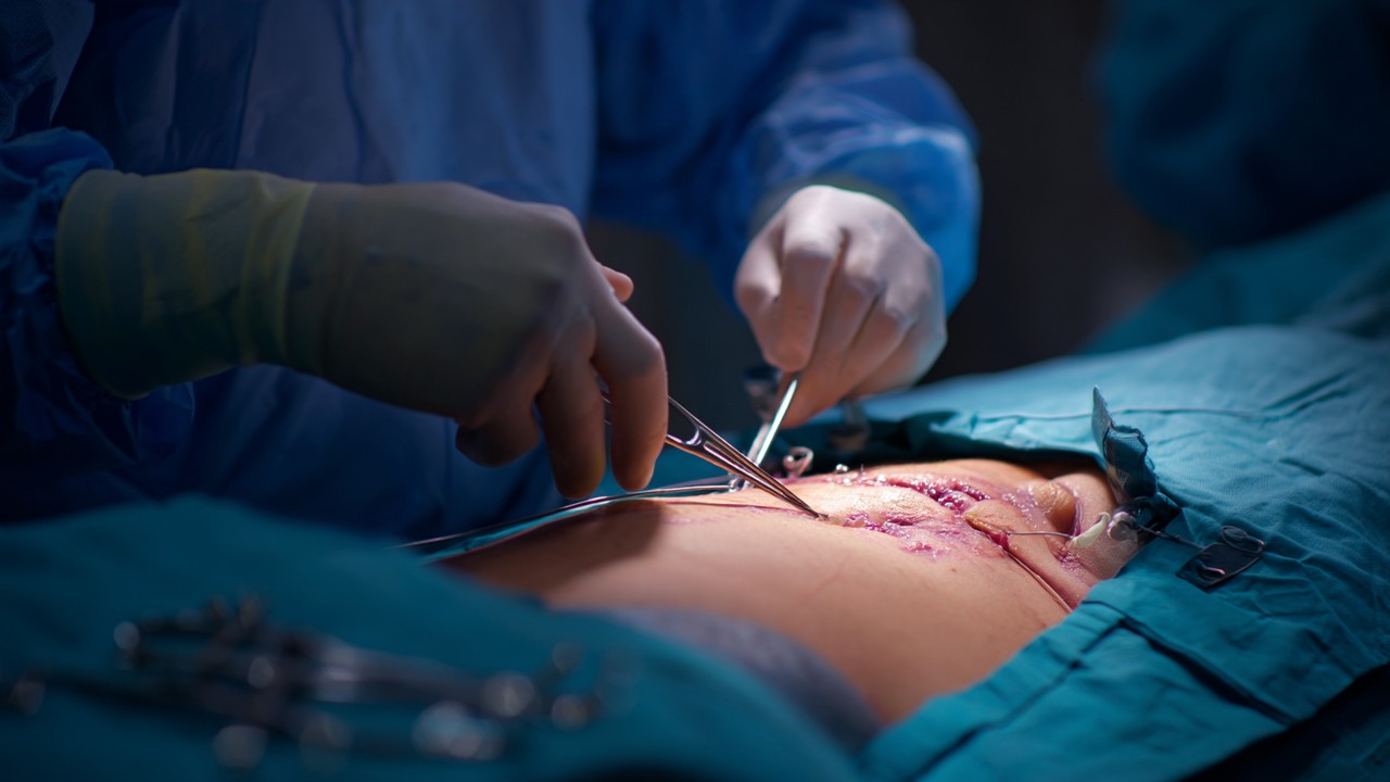Close-up of a surgeon performing liposuction in a sterile operating room, showing surgical instruments and fat extraction from the abdomen.